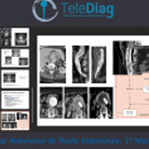 Replay Webinar Anévrysme Aorte Abdominale